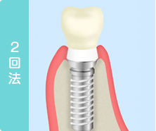 インプラント埋入手術について
