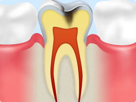 歯が痛い・しみる（一般歯科）