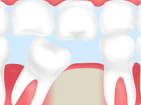 歯がグラグラする（歯周病治療）