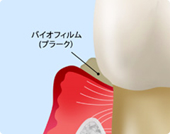 歯周病の原因