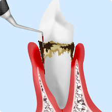 知っておきましょう、歯周病のこと
